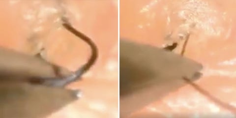 This Is What Ingrown Hair Removal Looks Like Close Up