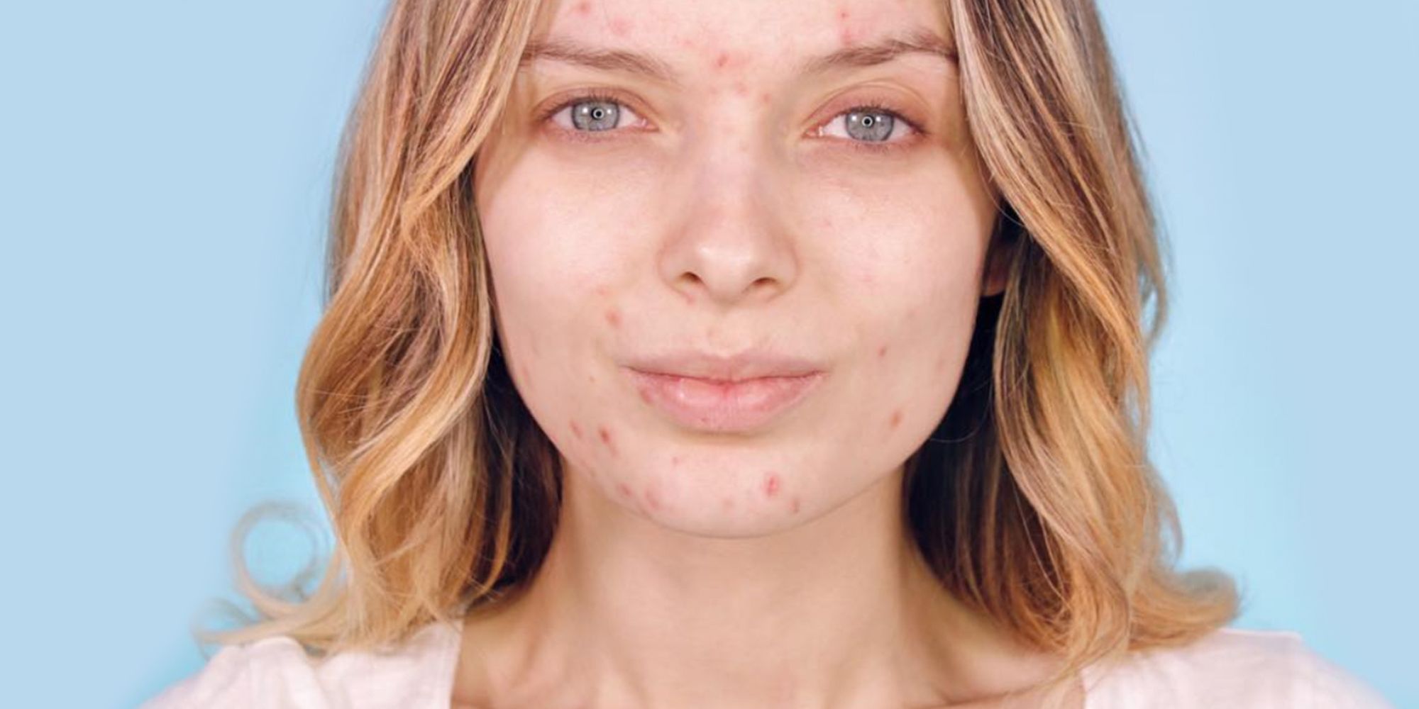 Why People Are Posting Acne Photos On Instagram Skin Positivity