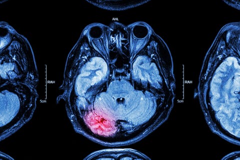 brain mri