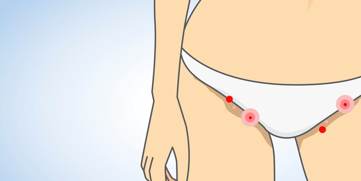 8 Common Causes Of Itchy Bumps And Lumps Around Your Vagina