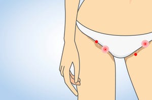 How To Get Rid Of An Ingrown Pubic Hair On Your Vagina