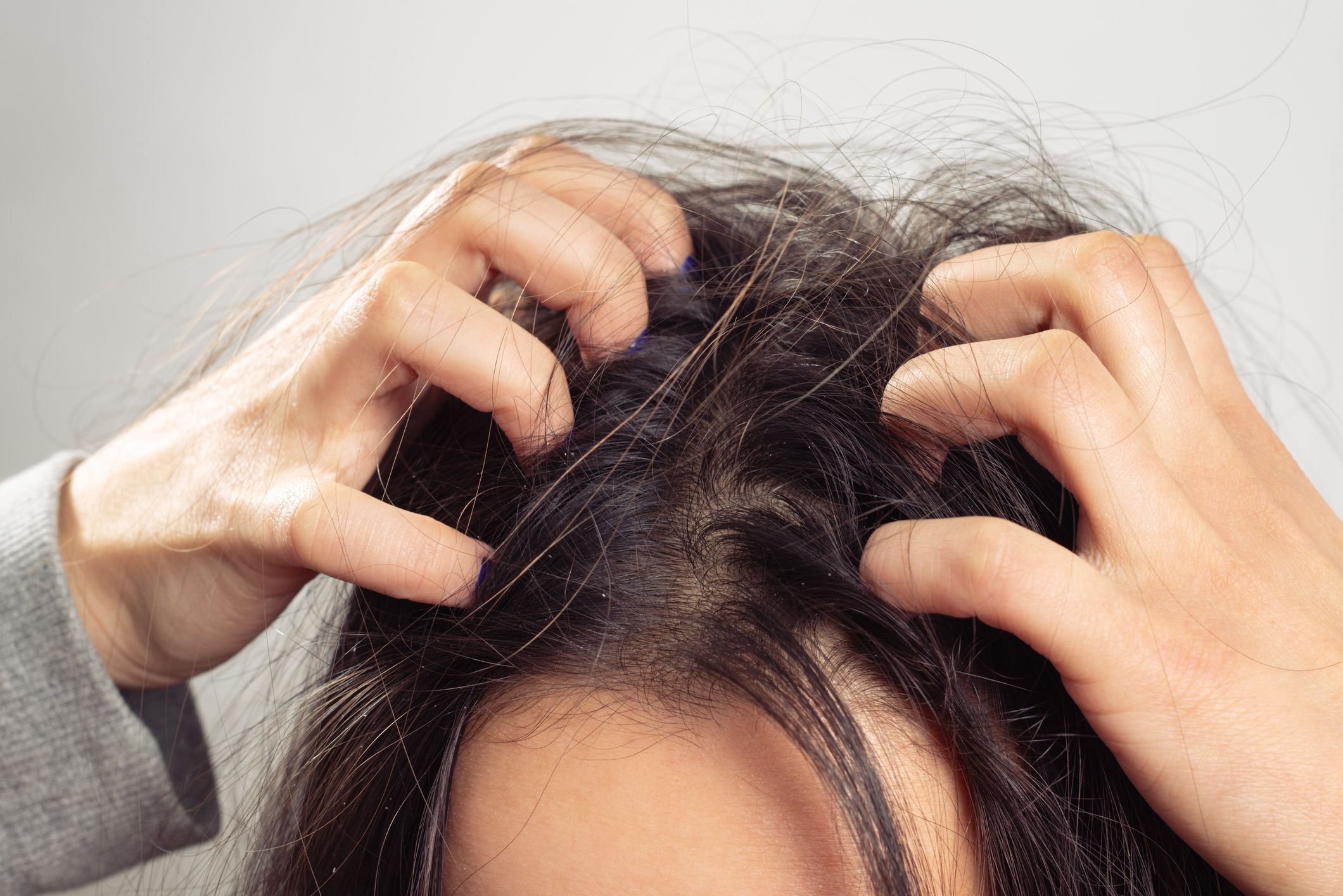 How an Itchy Scalp Is Treated