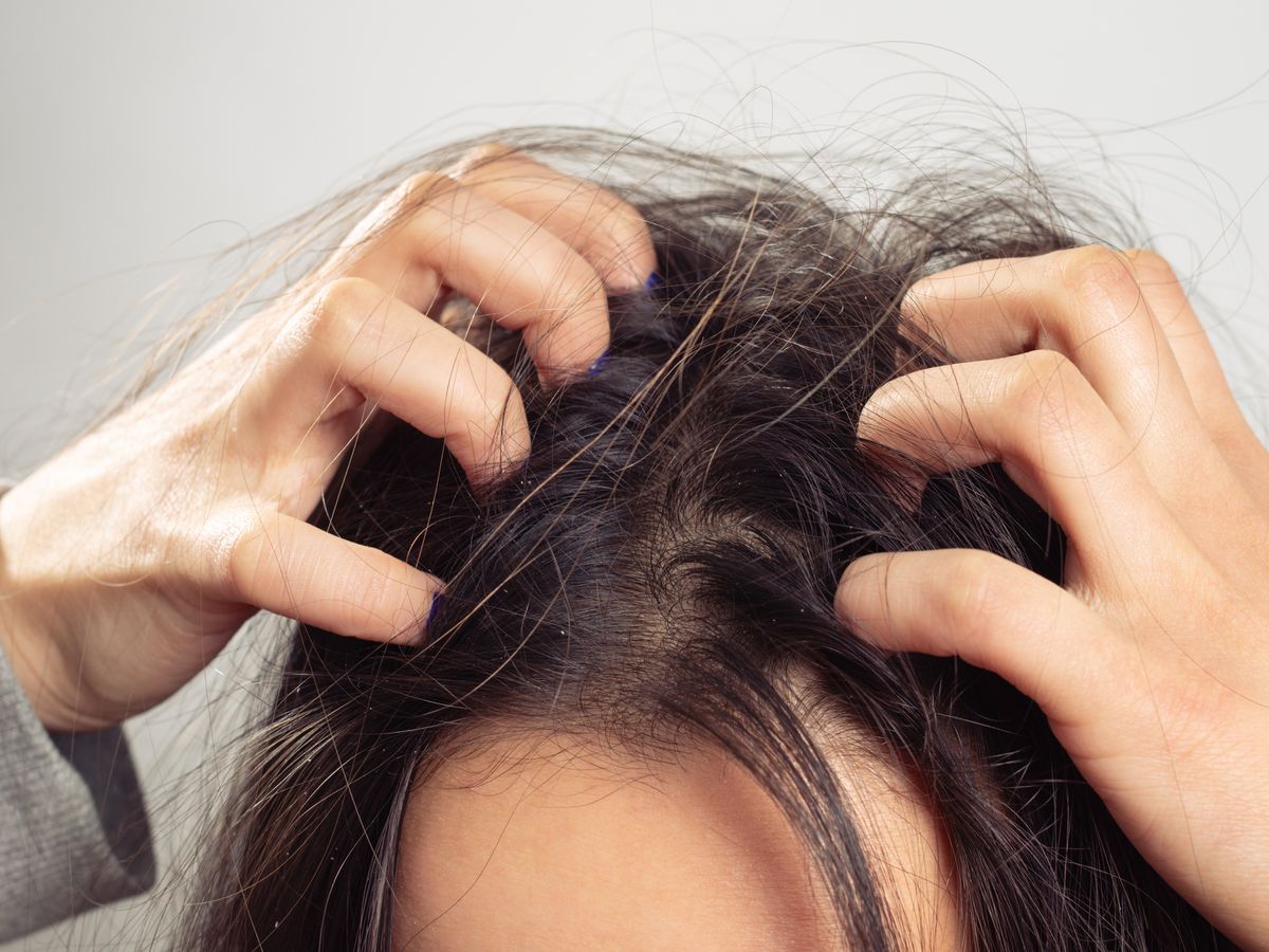Itchy scalp causes treatments