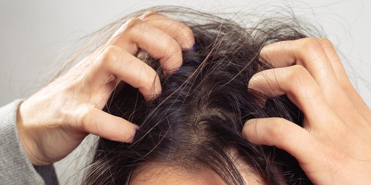 Itchy scalp causes and treatments