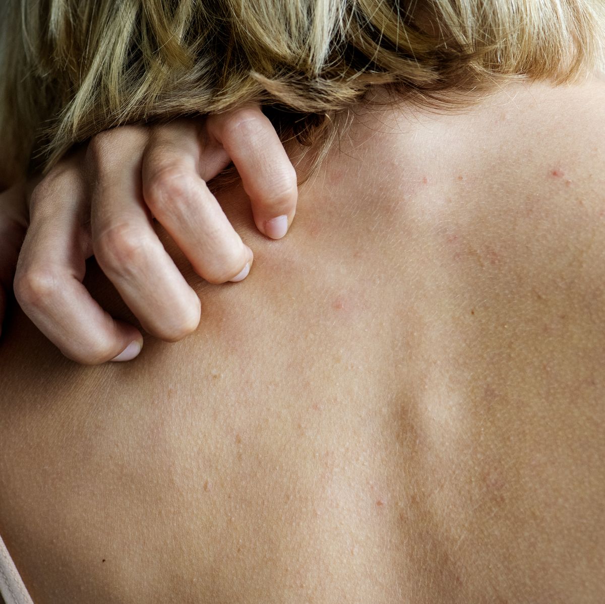 Itchy skin: 14 causes, pictures and treatments