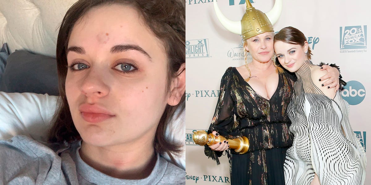 Joey King Reveals Bump on Head After Getting Hit with a Golden Globe