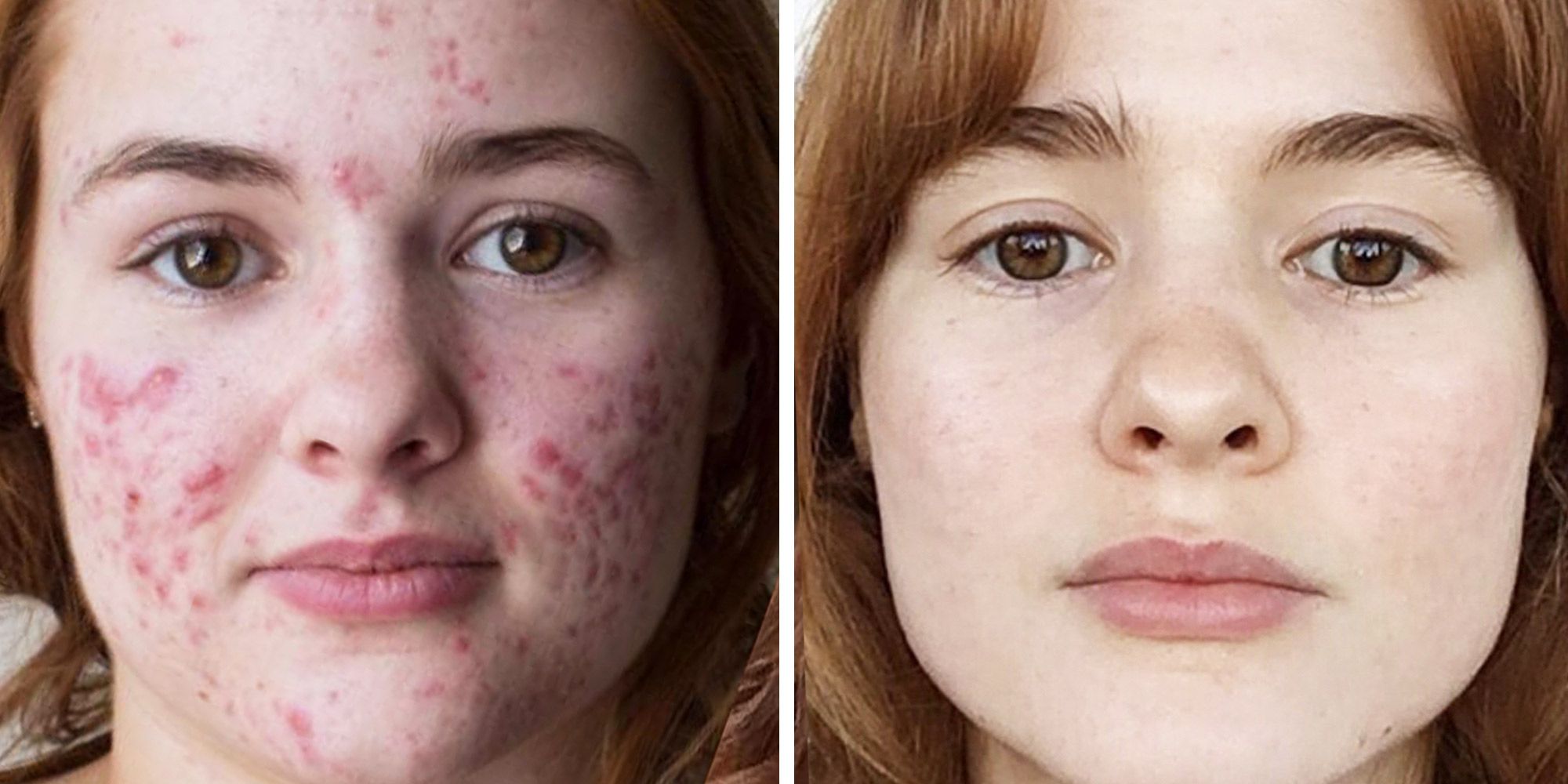 The Best Accutane Before And After Results Kali Kushner Of Myfacestory