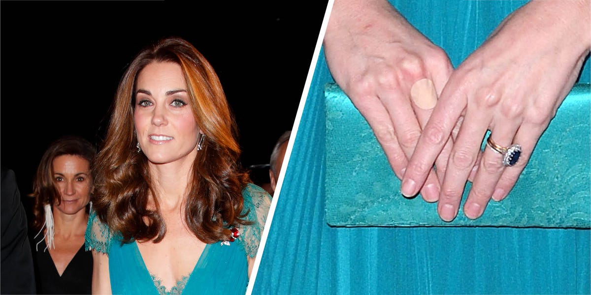 Why does Kate Middleton always have plasters on her hands 