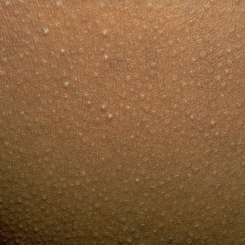 A Guide To Raised Bumps On Your Skin Red Moles Brown Spots Cysts