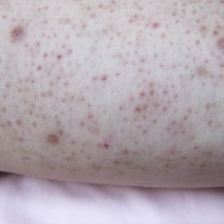 13 Common Causes For Itchy Butt Rashes And Bumps According To Mds