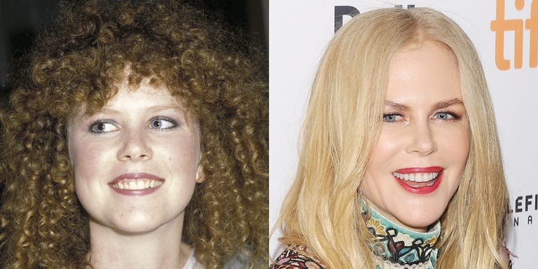 Celebrity Smiles Before and Afters - Celebrity Dental Work