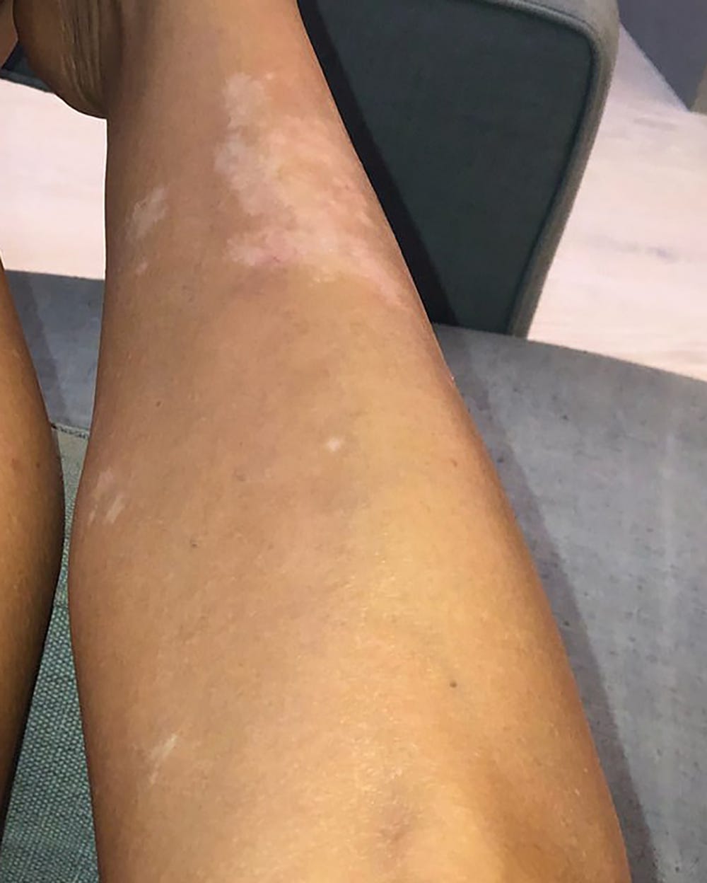 Kim Kardashian Psoriasis flare