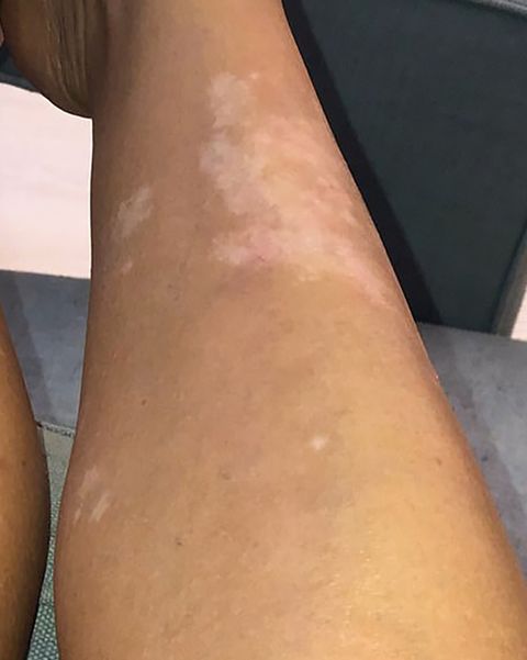 psoriasis scars images
