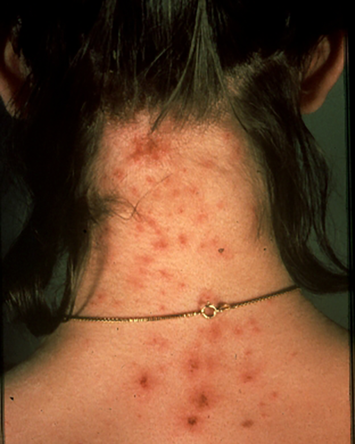 Head Lice Pictures What Does A Lice Bite Look Like Head Lice Pictures What Does A Lice Bite Look Like