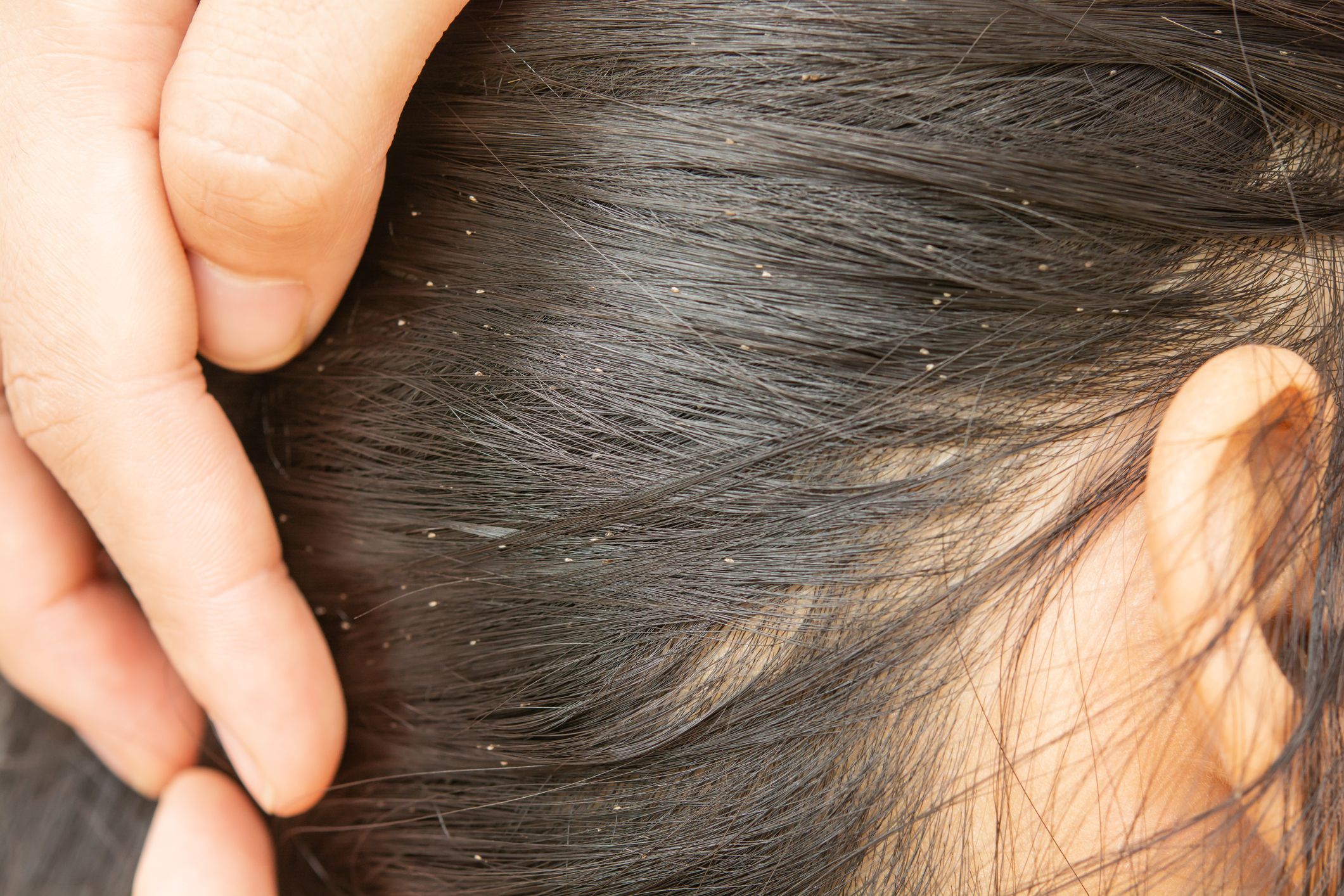 human hair head lice