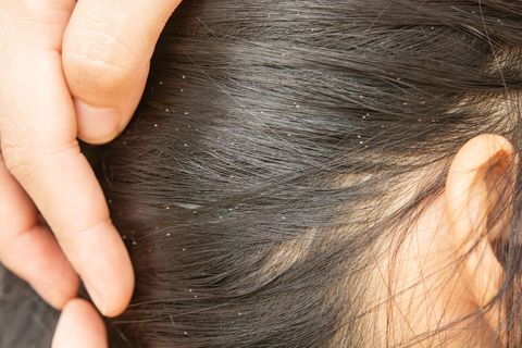 Lice Vs Dandruff How To Tell Difference Between Lice Dandruff