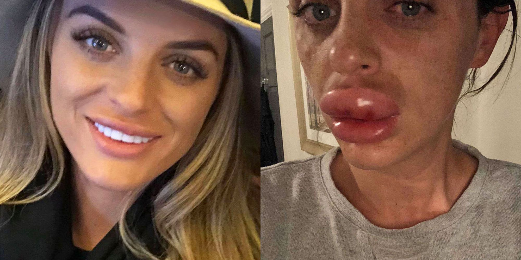 25 Most Popular Celebrities With Lip Fillers: Before And After With Images