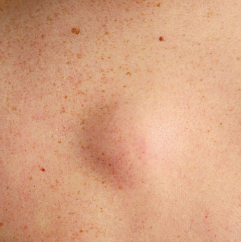 Bikini lump line skin on under A bump