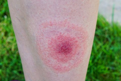 lyme disease, borreliosis or borrelia, typical lyme rash, spot