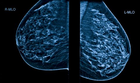 A Mammogram image showing left and right breasts