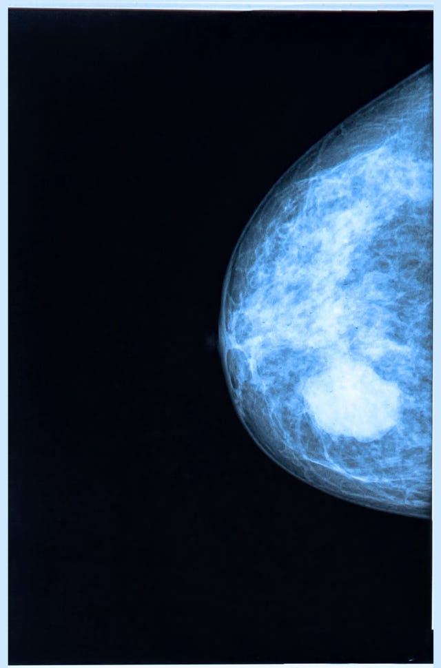 How Does Your Breast Feel When You Have Breast Cancer - What Are The Symptoms Of Breast Cancer Cdc / The vast majority of breast cancers are diagnosed in women over the.