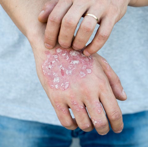 autoimmune psoriasis