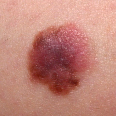 6 Melanoma Symptoms to Show Your Doctor Now - Melanoma Monday 6 Melanoma Symptoms to Show Your Doctor Now - Melanoma Monday
