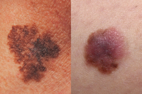 melanoma skin cancer pictures