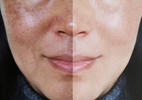 tratament melasma faciala injectari acid hialuronic