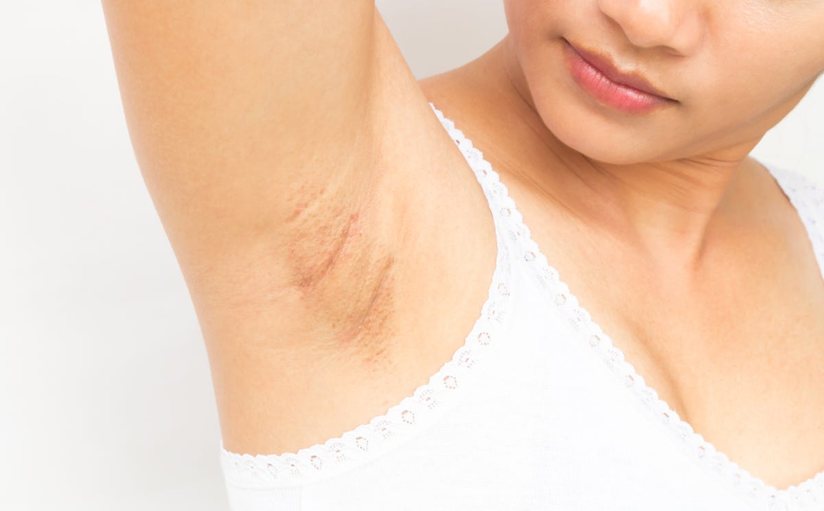 What Causes Cysts In Armpits