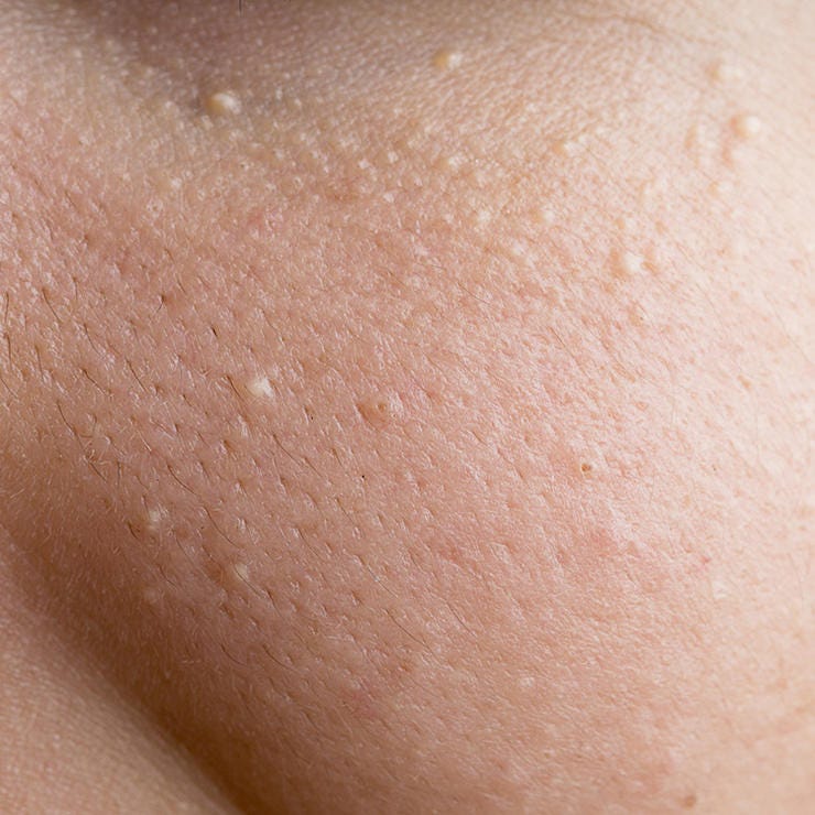 raised-skin-bump-25-causes-photos-treatments-bacana