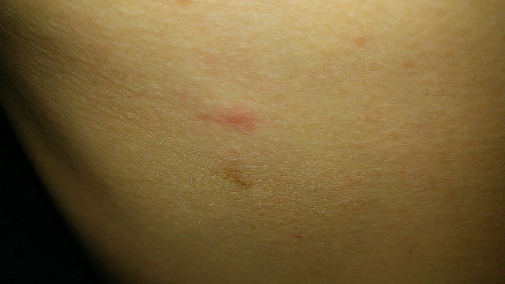 Cortisone Creams Are Powerful Skin Healers For Bites and Rashes Cortisone Creams Are Powerful Skin Healers For Bites and Rashes