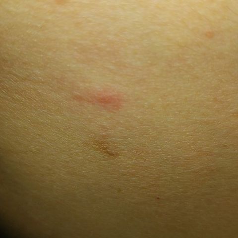 Insect bites and stings: pictures, symptoms and treatment