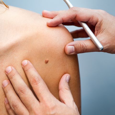 How to check your moles for signs of skin cancer.