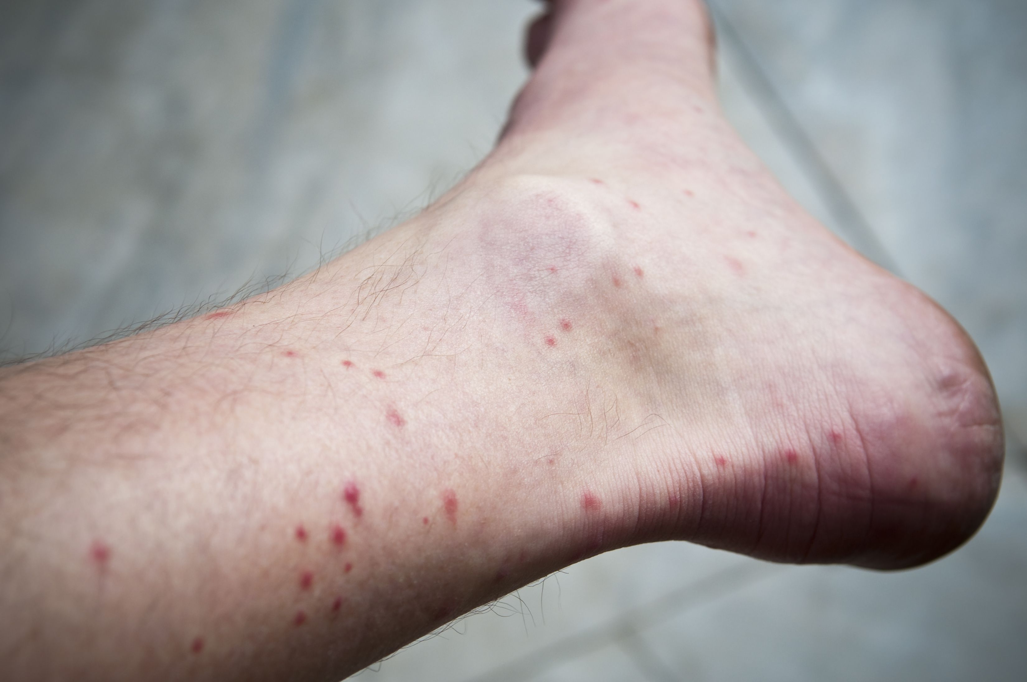 Cortisone Creams Are Powerful Skin Healers For Bites and Rashes Cortisone Creams Are Powerful Skin Healers For Bites and Rashes
