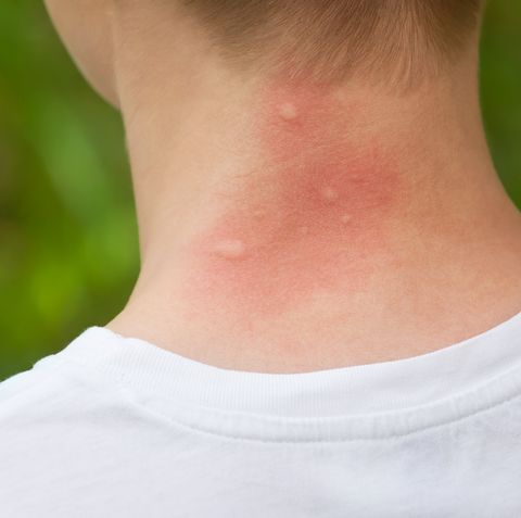 Allergic to mosquito bites symptoms