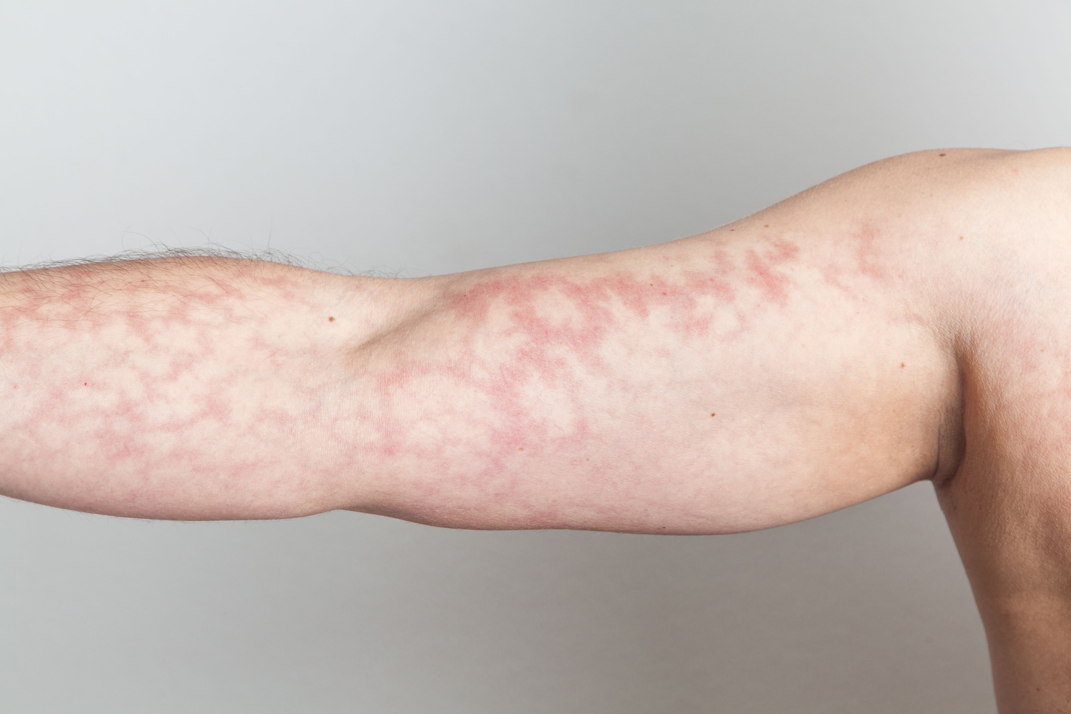 causes of rash purple