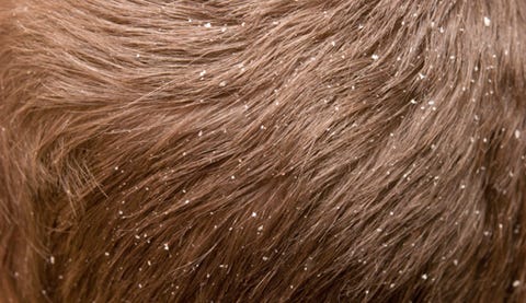 Dandruff Shampoo And Other Tips Prevention