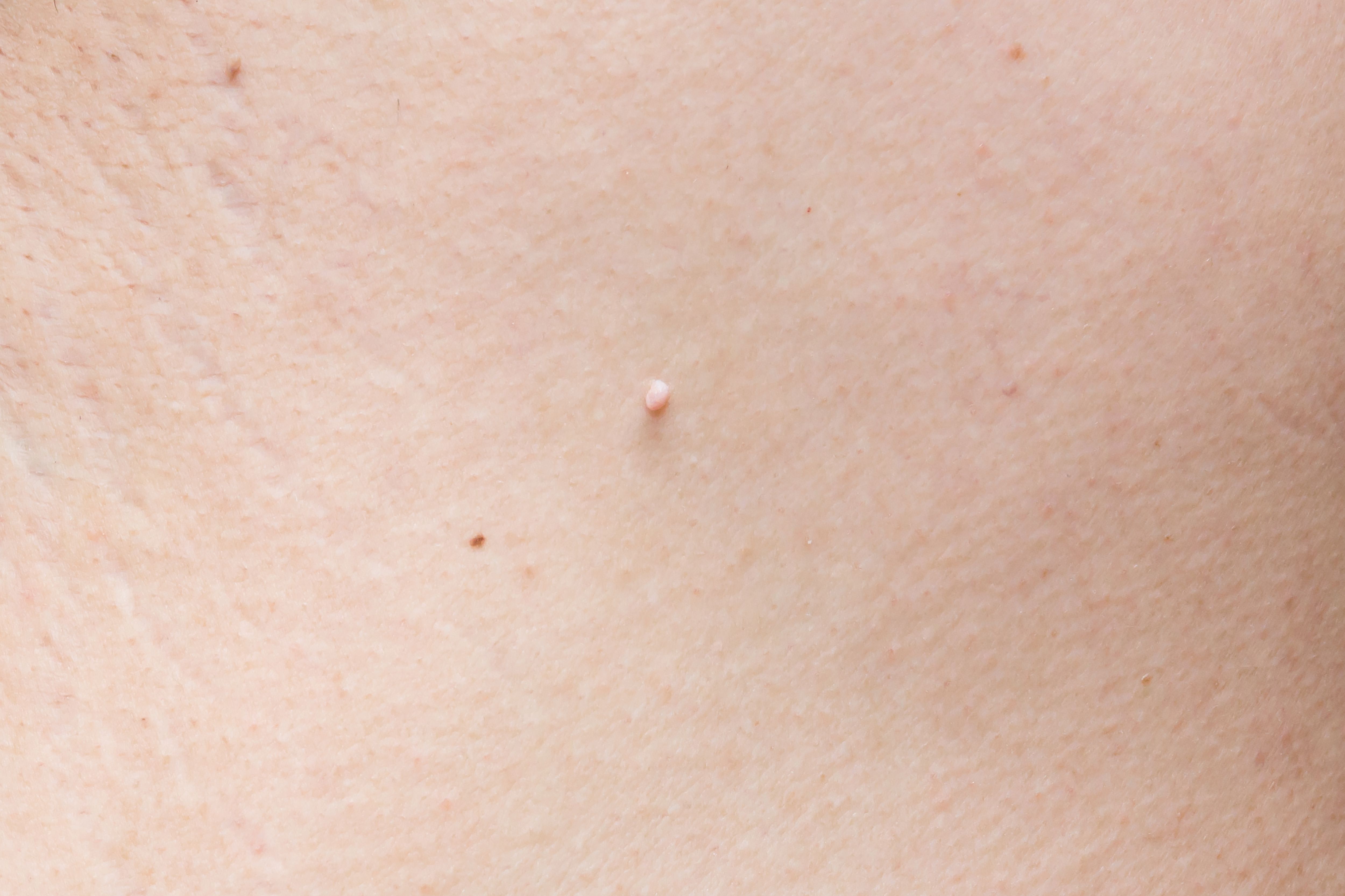папилломы на груди у женщин фото 99