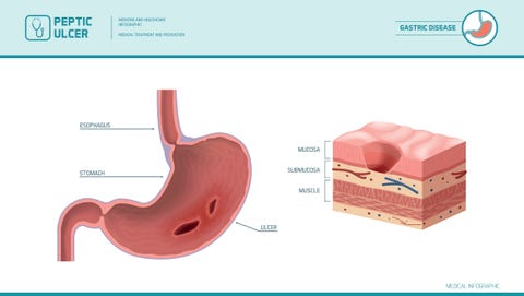 Peptic ulcer nausea