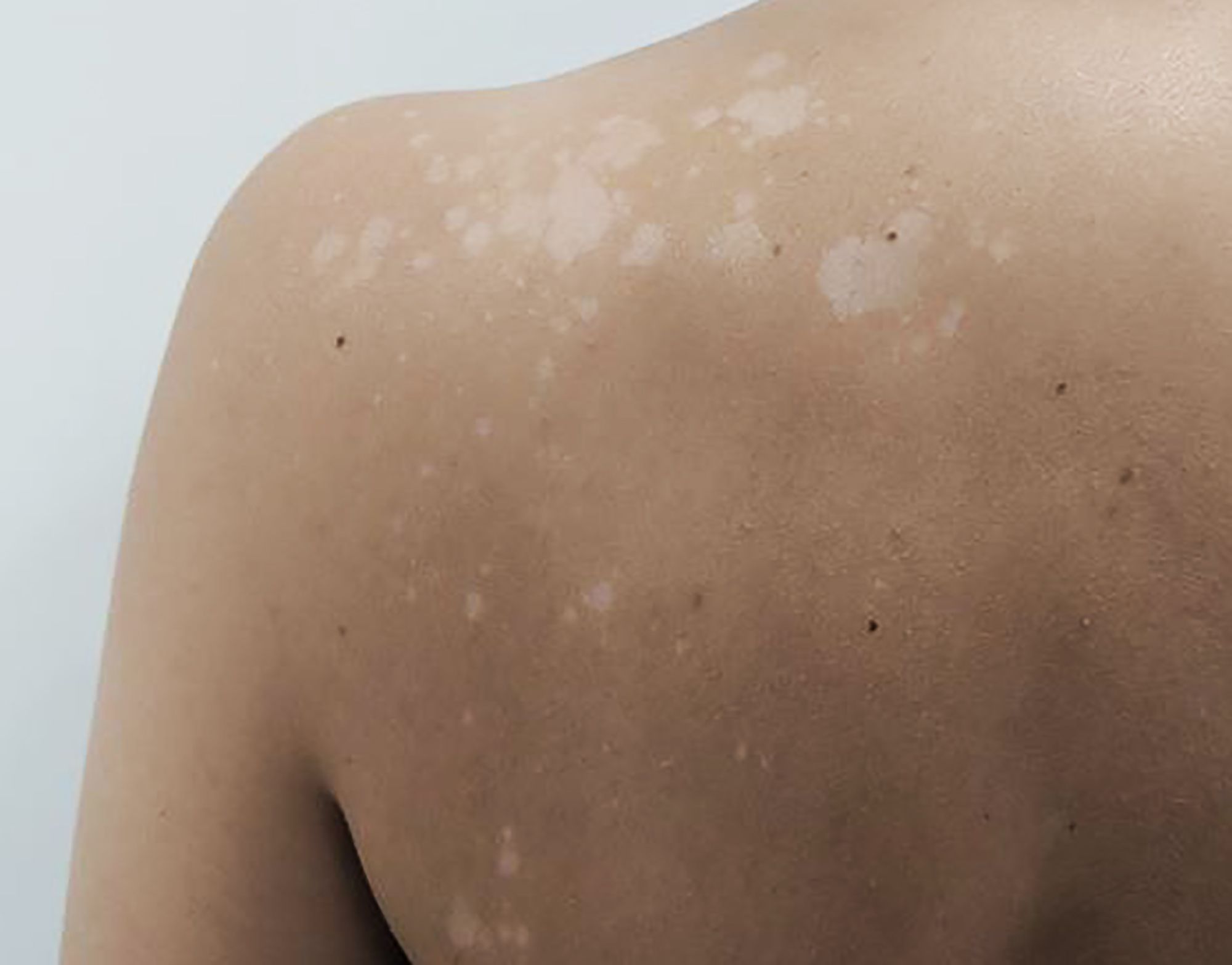 O que causa manchas brancas na pele?
