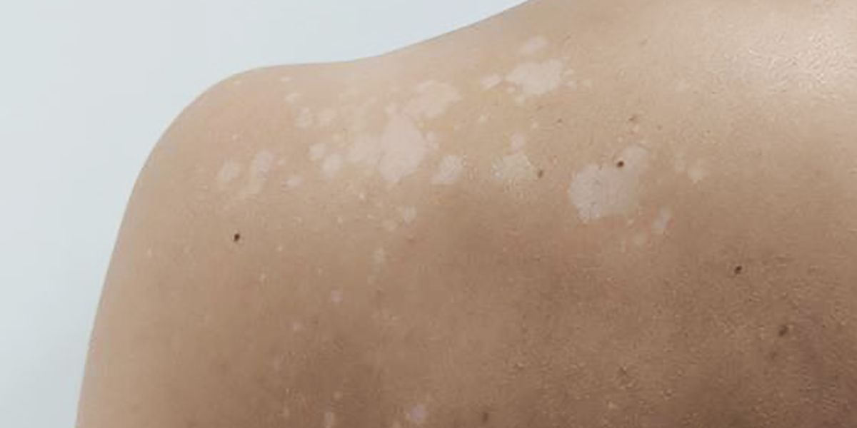 Skyldig Martyr dræne What is pityriasis versicolor? The white patches you might get on your skin