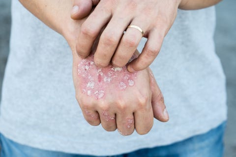 Psoriasis 101 - Symptoms, Causes, Treatments, & Pictures