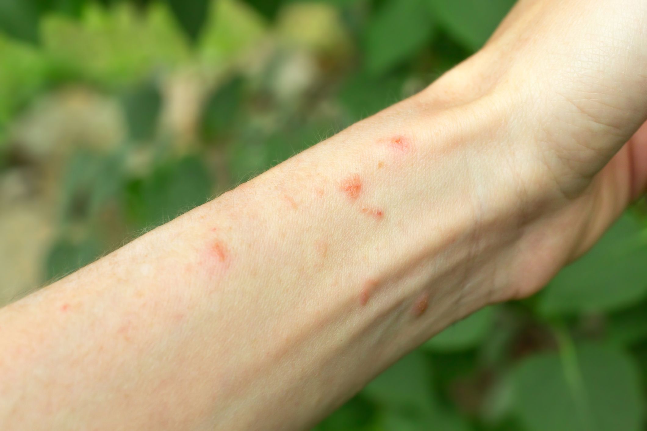 itchy skin bumps on arms