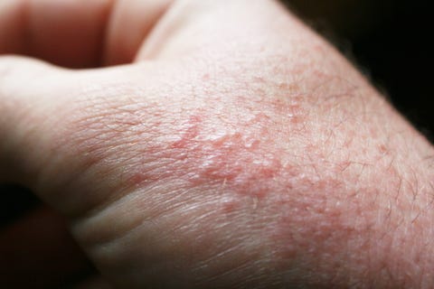 What Does a Poison Oak Rash Look Like? - Poison Oak Pictures