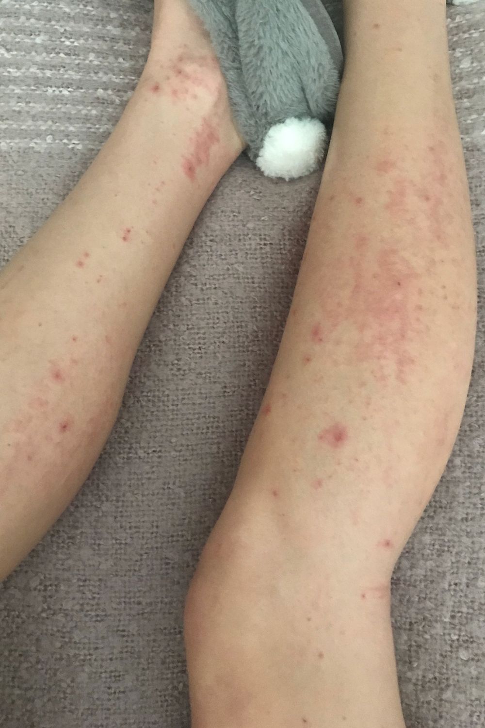 how-to-treat-red-spots-on-skin-what-causes-red-bumps-on-body