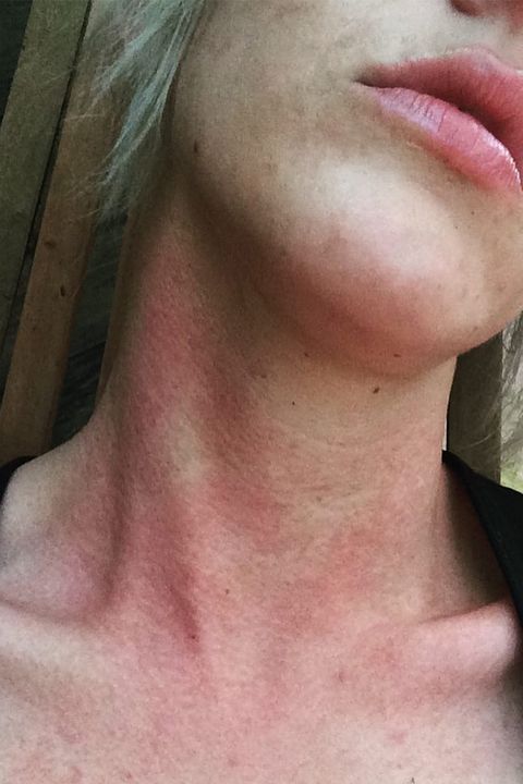 Nose Bump Porn - How to Treat Red Spots on Skin - What Causes Red Bumps on Body?