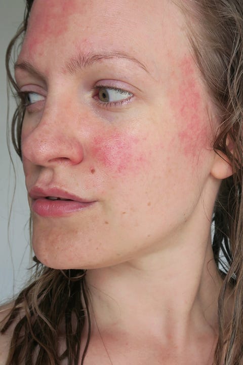 Red Inflamed Pores On Face Acne Symptoms