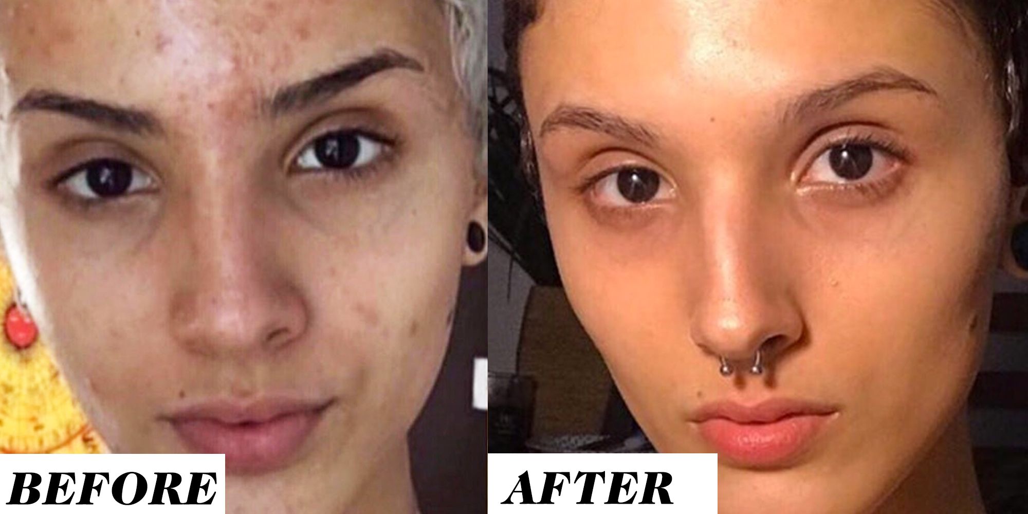 Before-and-After Retinol Results