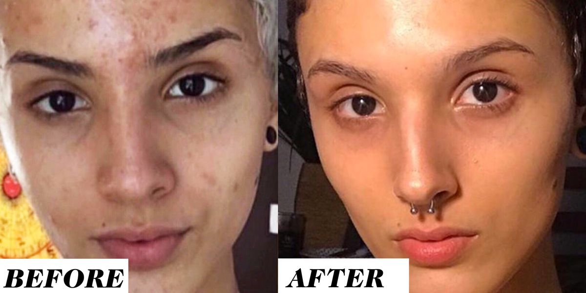 This Woman S Before And After Retinol Results Are Going Viral On Reddit